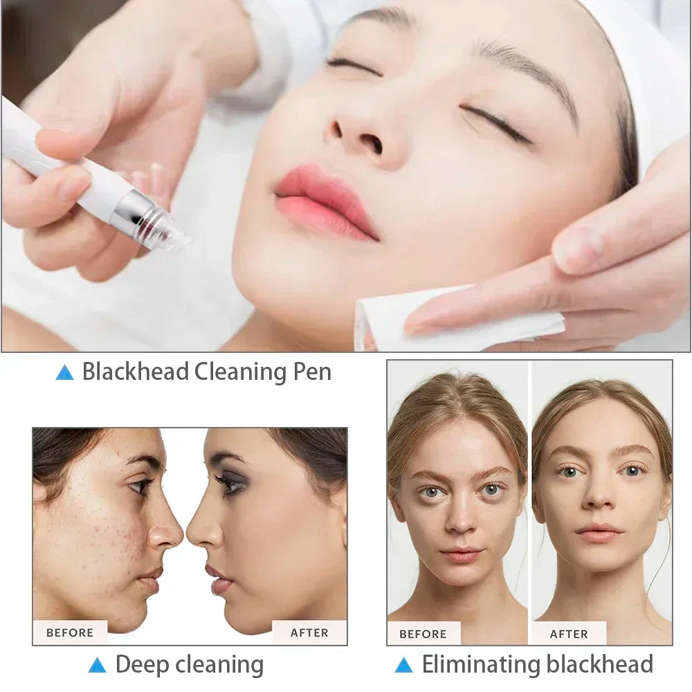 Missheart Professional Beauty Facial Machine  Hydra Aqua Deep Cleaning Skin Care Device（ EU /UK /US Fast Shipping）